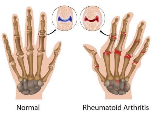 Copper Hands Arhtritis Hand Gloves